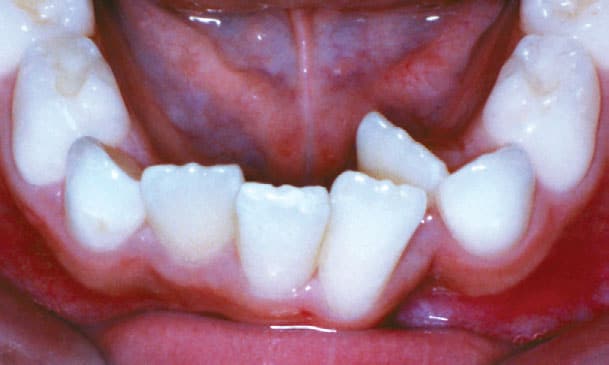 Crowding Shlash Orthodontics in Olney, MD