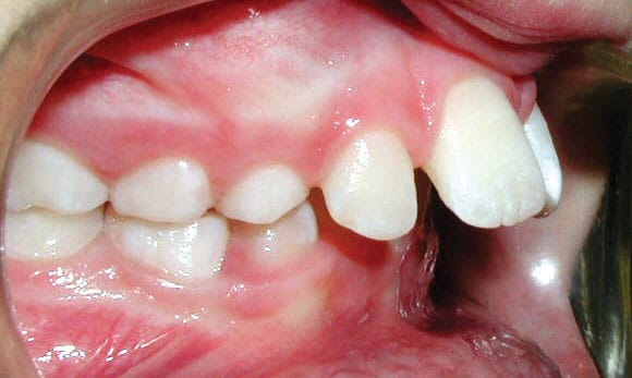 Protrusion Shlash Orthodontics in Olney, MD