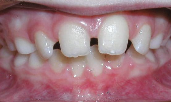 Spacing Shlash Orthodontics in Olney, MD