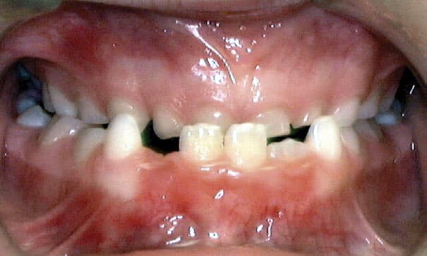 Underbite Shlash Orthodontics in Olney, MD